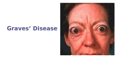 <ul><li><p>overproduction of thyroxine is called <strong>hyperthyroidism</strong></p></li></ul><p></p><ul><li><p>because metabolism is increased, symptoms may include:</p><ul><li><p>anxiety</p></li><li><p>insomnia</p></li><li><p>difficulty concentrating</p></li><li><p>heat intolerance</p></li><li><p>irregular heartbeat</p></li><li><p>high blood pressure</p></li><li><p>excessive weight loss</p></li></ul></li></ul><p></p><ul><li><p>severe hyperthyroidism is a condition called <strong>graves’ disease</strong></p><ul><li><p>whereby sufferers display a characteristic protrusion of their eyes, thus interfering with vision</p></li><li><p>hyperthyroidism can be treated via medications or removal / irradiation of portions of the thyroid gland</p></li></ul></li></ul><p></p>