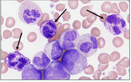 <p>- Most infrequent leucocyte (0.1 x109/L)</p><p>- Diameter of about 12 micrometres</p><p>- Large round purple-black cytoplasmic granules that overlie nucleus; nucleus has two segments</p><p>- Granules: histamine; tryptase</p><p>- Role: immune responses to parasites</p><p>.</p><p>- we use basophils in another way to make diagnosis of chronic myeloid leukaemia. the pointed basophils dont look like normal ones (top right of slide) because they are hypogranular and now we can see the nucleus</p>