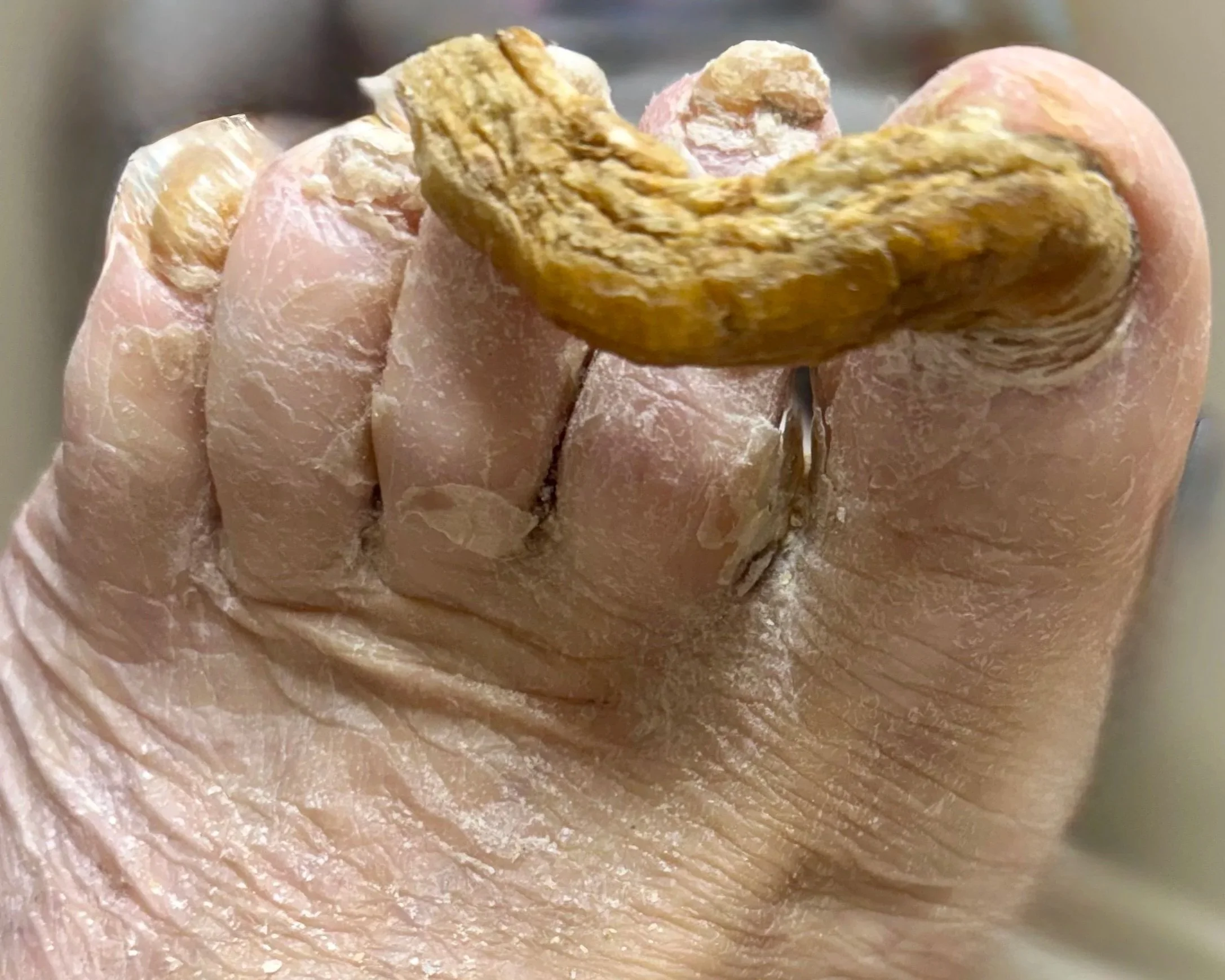 <ul><li><p>fibrous structural protein, outer layer of skin</p></li><li><p>there is alpha an beta keratins</p></li><li><p>onychomycosis</p></li></ul><p></p>