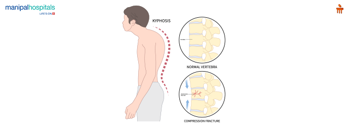 <p><span>Kyphoscoliosis</span></p>