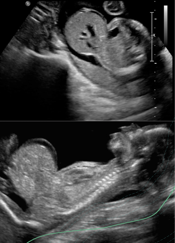 <ul><li><p>abdominal wall <span style="color: red;">mass </span><span style="color: rgb(255, 255, 255);">should be</span><span style="color: red;"> continuous with umbilical cord</span></p><ul><li><p><span style="color: yellow;">Doppler</span> to demonstrate intrahepatic <span style="color: yellow;">umbilical vein coursing through defect</span></p></li></ul></li><li><p><span style="color: red;">membranous sac </span>should be identified <span style="color: red;">covering</span> contents</p><ul><li><p>document size; increased AC</p></li></ul></li><li><p>identify contents of membranous sac</p><ul><li><p>bowel only; liver in and out of sac</p></li></ul></li><li><p>hydramnios is common</p></li></ul><p></p>