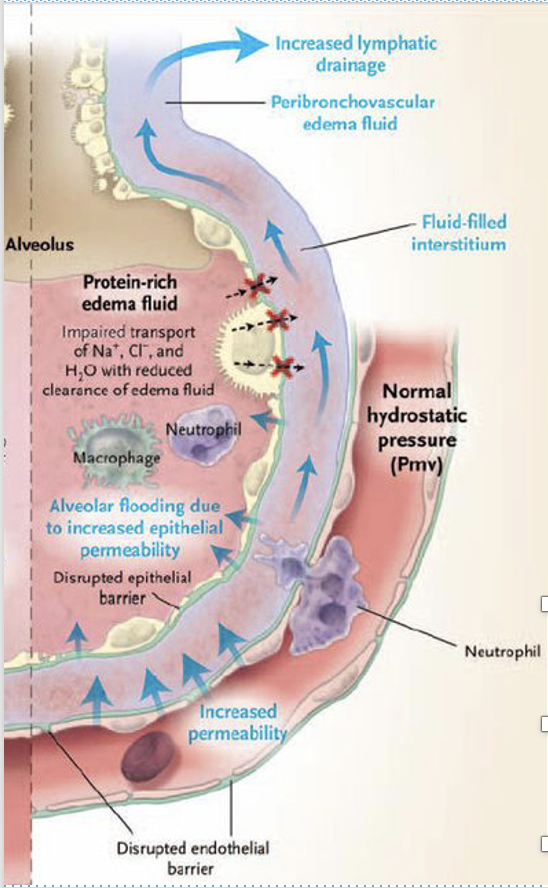 <ul><li><p><span><span>The submucosa of the alveoli is targeted, causing inflammation and secondary oedema, microhaemorrhage, and cellular immune reaction.</span></span></p></li><li><p><span><span>Cellular reaction consists of mononuclear lymphocytes and progresses to polymorphonuclear neutrophil recruitment. Fibrin is released.</span></span></p></li><li><p><span><span>CD4 and CD8 cells begin a cascade of immune product secretion that can end in increased vascular permeability and oedema.</span></span></p></li><li><p><span><span>May lead to intra-alveolar organization and an obliterans clinical picture.</span></span></p></li><li><p><span><span>Can develop into interstitial pneumonia, pulmonary oedema, and cardiogenic shock</span></span></p></li></ul><p></p>