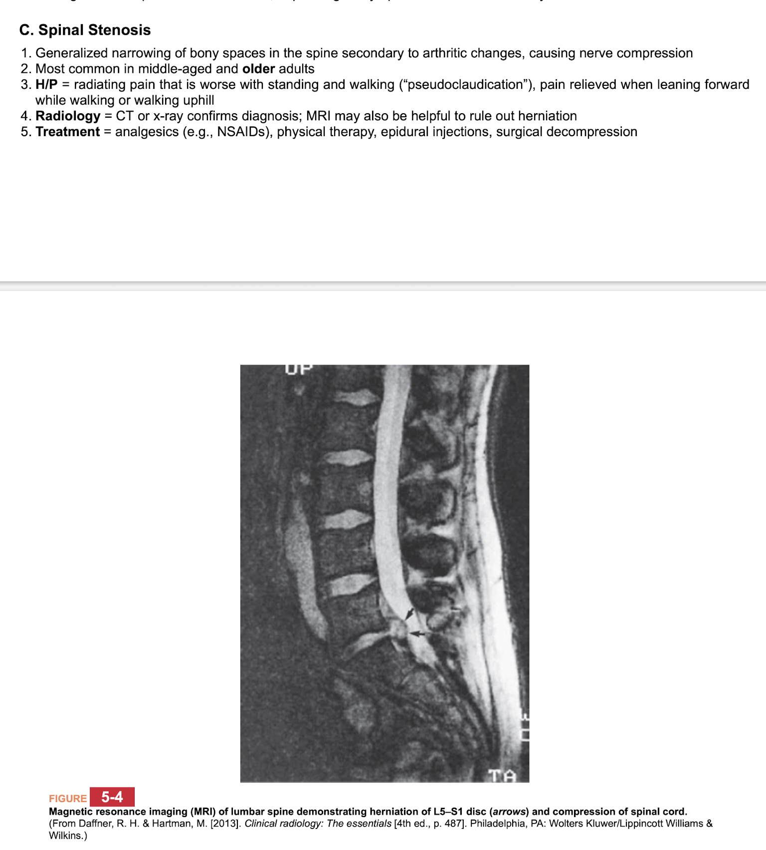 <p class="p1"></p><p class="p2">Secondary to arthritic changes, causing nerve compression&nbsp;</p><p class="p1"></p><p class="p2">Common in middle age and older adults&nbsp;</p><p class="p1"></p><p class="p2">Pain better with leaning forward&nbsp;</p><p class="p2">Worse with standing and walking&nbsp;</p><p class="p1"></p><p class="p2">CT/XRAY to confirm. MRI can help r/o herniation&nbsp;</p><p class="p1"></p><p class="p2">Tx: conservative, NSAIDS&nbsp;</p>