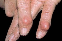 <p>A solid bump that is usually larger than one centimeter</p>