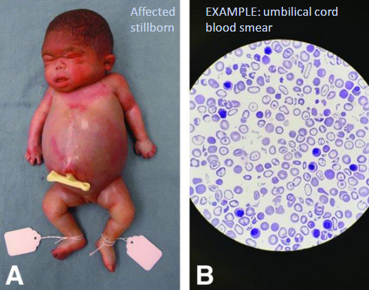 <ul><li><p>loss of all 4 globin genes (- -/ - -)</p></li><li><p>y-tetramers (4 y-subunits) form w/ extremely high affinity for O2 → anoxia → fetal IU death</p></li><li><p>if baby born → severe pallor, generalized edema, massive hepatosplenomegaly</p></li><li><p>peripheral smear → severe hypochromic microcytic anemia, anisopoikilocytosis, nucleated erythroid forms (normoblasts), target cell</p></li></ul><p></p>