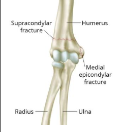 <p>Supracondylar fracture</p>