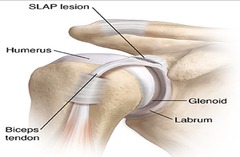 <p>Superior labrum tear at biceps insertion.</p>