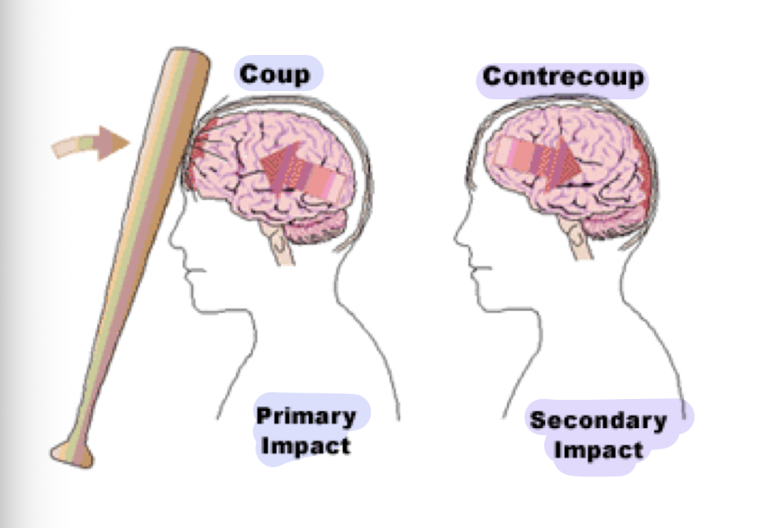 <p>What is contrecoup?</p>
