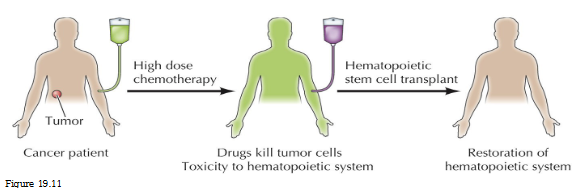 <p>Cancer patient receives high dose chemotherapy</p><p>Drugs kill tumor cells </p><p>Toxicity to hematopoietic system</p><p>Hematopoietic SC transplant = restoration of hematopoietic system</p>