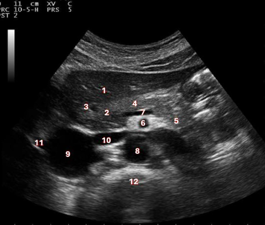 <p>What structure/vessel is indicated by #7?</p><p>a. splenic artery</p><p>b. superior mesenteric vein</p><p>c. splenic vein </p><p>d. superior mesenteric artery</p>