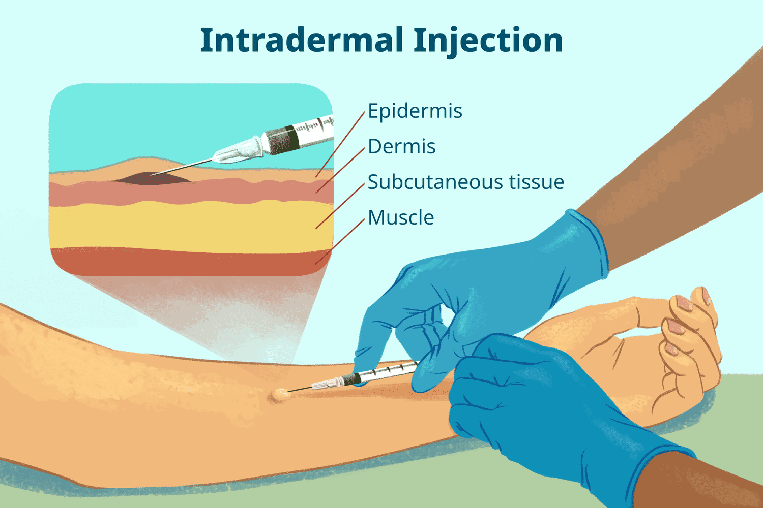 <p>injection though epidermis </p>