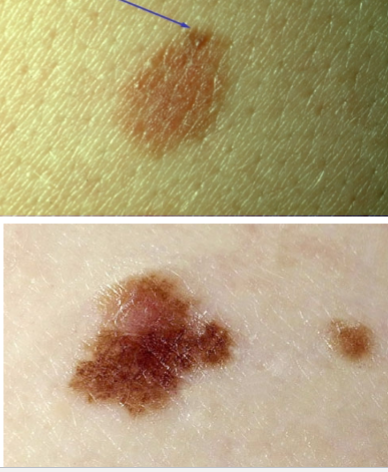 <p>Dysplastic (Atypical) Melanocytic Nevi - definition</p><ul><li><p>inc risk of ?</p></li><li><p>when do you want to excise?</p></li><li><p>benign or cancerous?</p></li></ul><p></p>