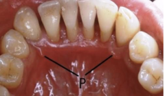 <p>ID the anatomic variant:</p>
