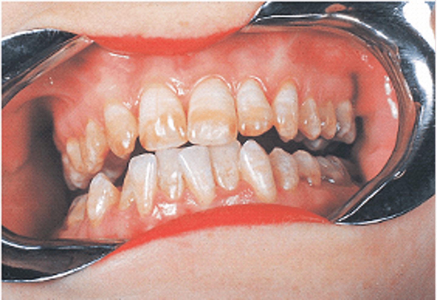 <p>Discoloration of enamel from high fluoride intake</p><p><br><span>The patient in this image is healthy with no local or systemic infection or disease. The patient's teeth are caries free, as are all of the teeth of all of the patients who exhibit this defect. What is this condition?</span></p>