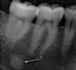 <p>borders ill defined, tooth is vital, does not have to be in a tooth bearing area </p>