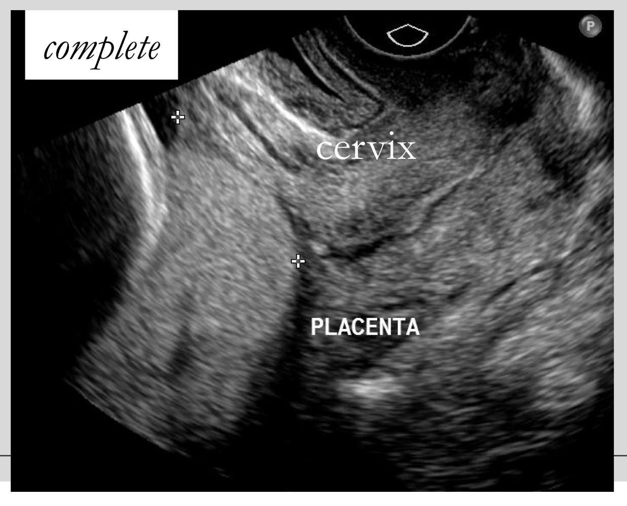 <p>Placenta completely covers the internal os</p>