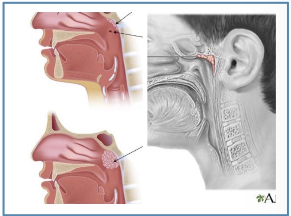 <p>Adenoidai (<span><span>randami viršutinėje užpakalinėje nosiaryklės dalyje. Vaikams būdingi ryškūs adenoidai iki 2–3 metų amžiaus)</span></span></p>