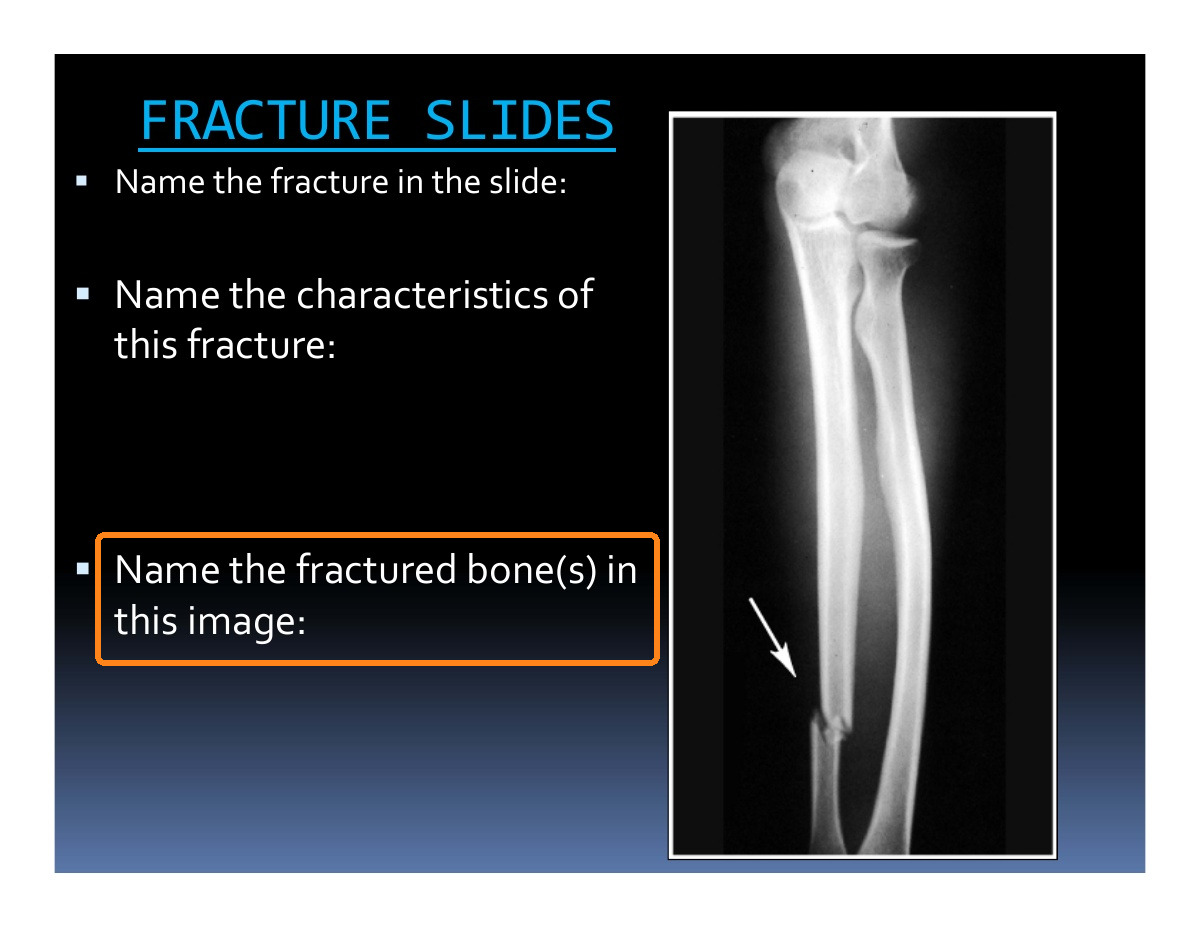 Name the fractured bone(s) in this image.