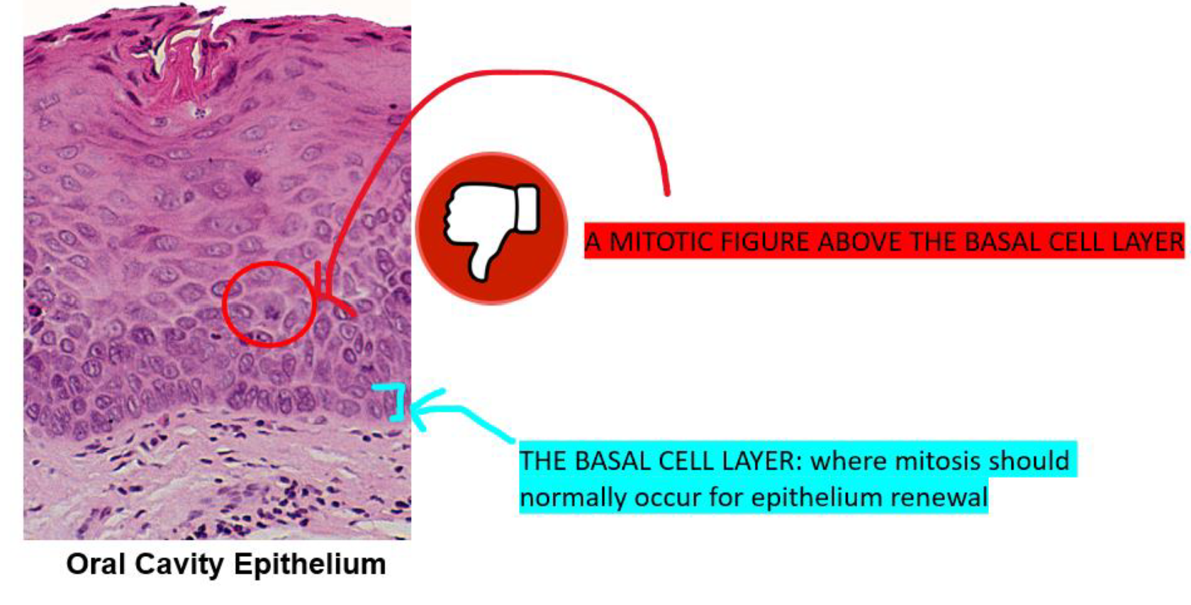<ul><li><p>Pre Cancerous Condition</p></li><li><p>Occurs if cell growth is occurring above the cell layer</p></li></ul><p></p>