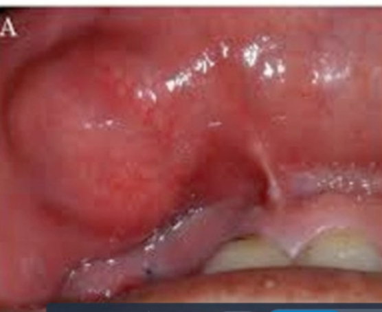 <p>DDx for firm enlarging mass lateral to midline in 55 y/o woman</p>