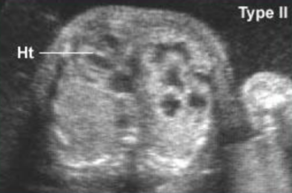 <ul><li><p><span style="background-color: transparent;">Multiple small cysts&nbsp;</span></p></li><li><p><span style="background-color: transparent;">Homogeneously echogenic lobes</span></p></li></ul><p></p>