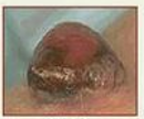 <p>What is the type of lesion and how is it defined?</p>