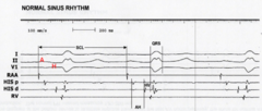 <p>- Atrial deflection HB EGM to his</p><p>- AVN conduction time 50-120ms</p><p>- Sympathetic stimulation = shorter A-H conduction time</p>