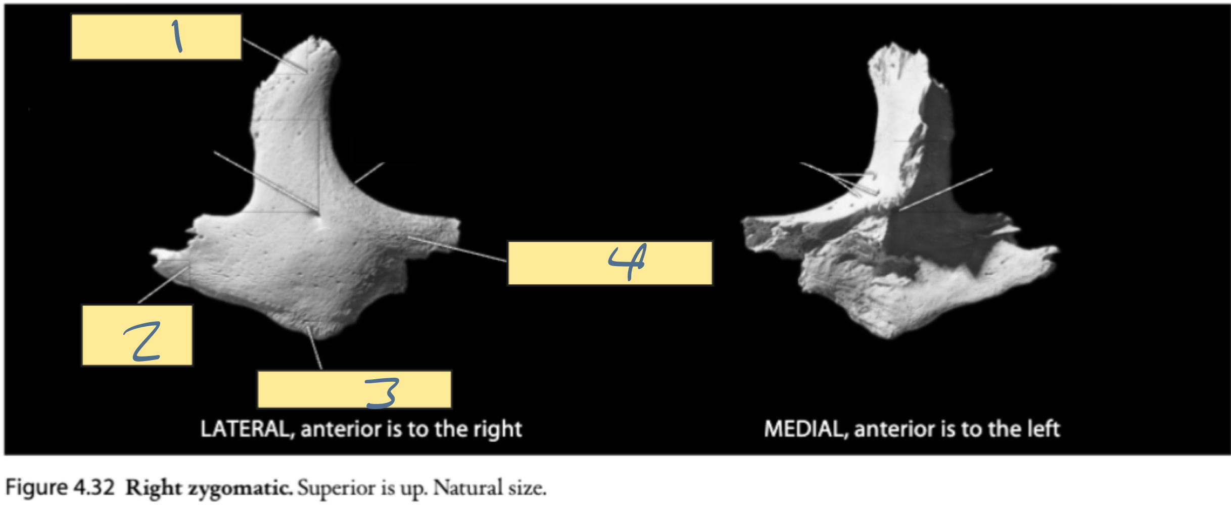 <p>siding the zygomatic:<br>orbital border is ___ and ___<br>anterior is ___ </p>