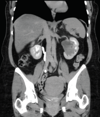 <p>blockage somewhere between the renal pelvis and the ureter </p><p>most common cause of hydronephrosis in neonates</p>