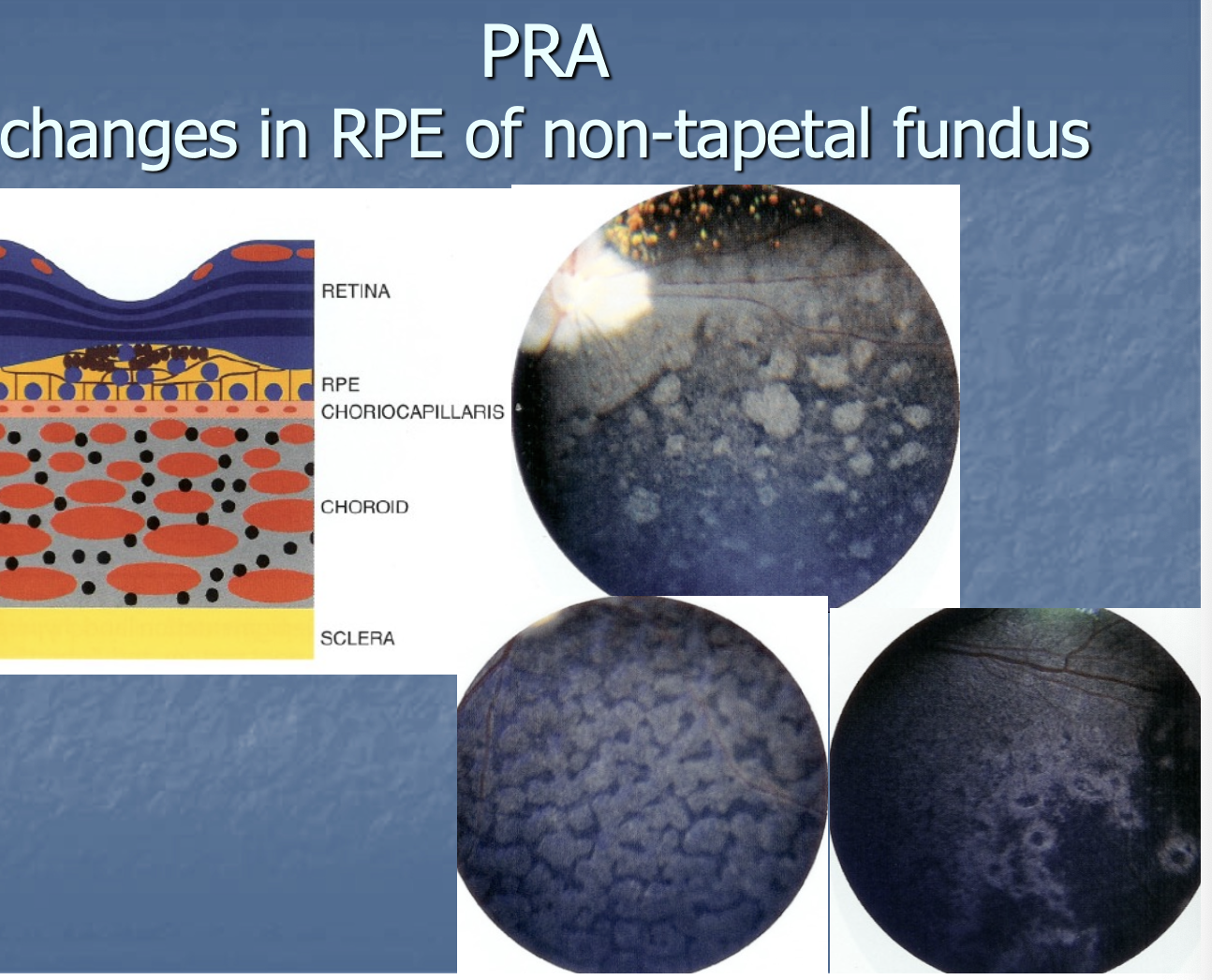 <p>changes in RPE of non-tapetal retina - may see pigment build-up.</p>