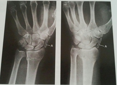 <p>Visualized on PA and oblique projections, Elongated and slightly convex in shape, Located between the radial collateral ligament and adjoining muscle tendons lateral to scaphoid</p>