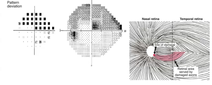 <p>arcuate defect </p>