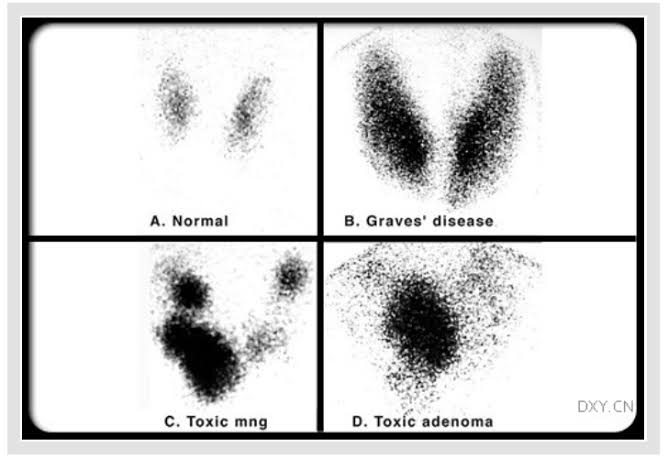 <p>toxic adenoma</p><p><sub><sup>(decr TSH, incr T3,4)</sup></sub></p>