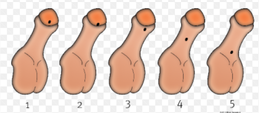 <p>Een aangeboren afwijking van de penis en de urethra waarbij de urethra op de foute plaats ligt.</p>