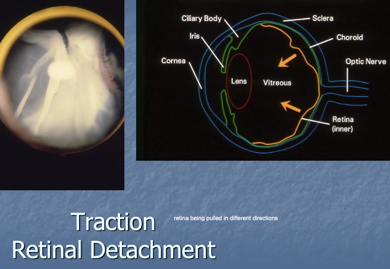 <p>retina pulled in different directions </p>