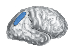 <ul><li><p><span style="background-color: transparent;">damage to the </span><span>right parietal cortex</span><span style="background-color: transparent;"> (e.g., stroke or accident)</span></p></li></ul><p></p>