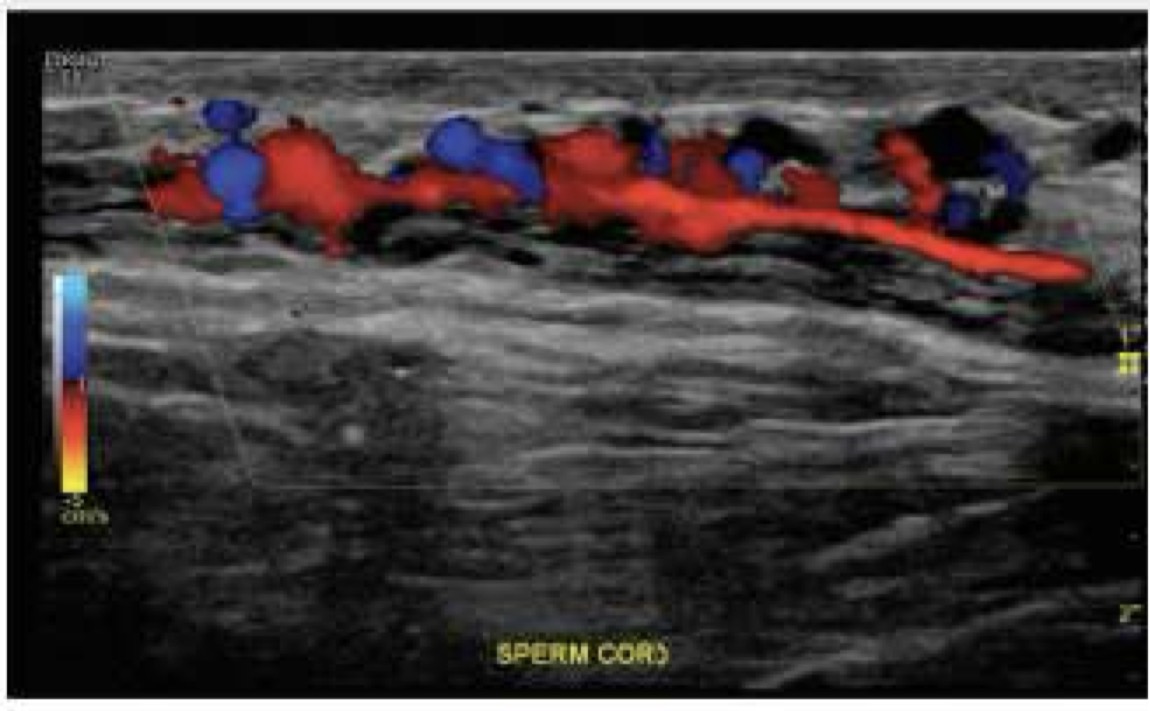 <p>Bilateral; extend from inguinal canal and internal inguinal ring into pelvis; each contains:</p><ul><li><p>ductus deferens</p></li><li><p>testicular arteries (on image)</p></li><li><p>venous pampiniform plexus (on image)</p></li><li><p>lymphatics</p></li><li><p>autonomic nerves</p></li><li><p>fibers of cremaster muscle</p></li></ul><p></p>