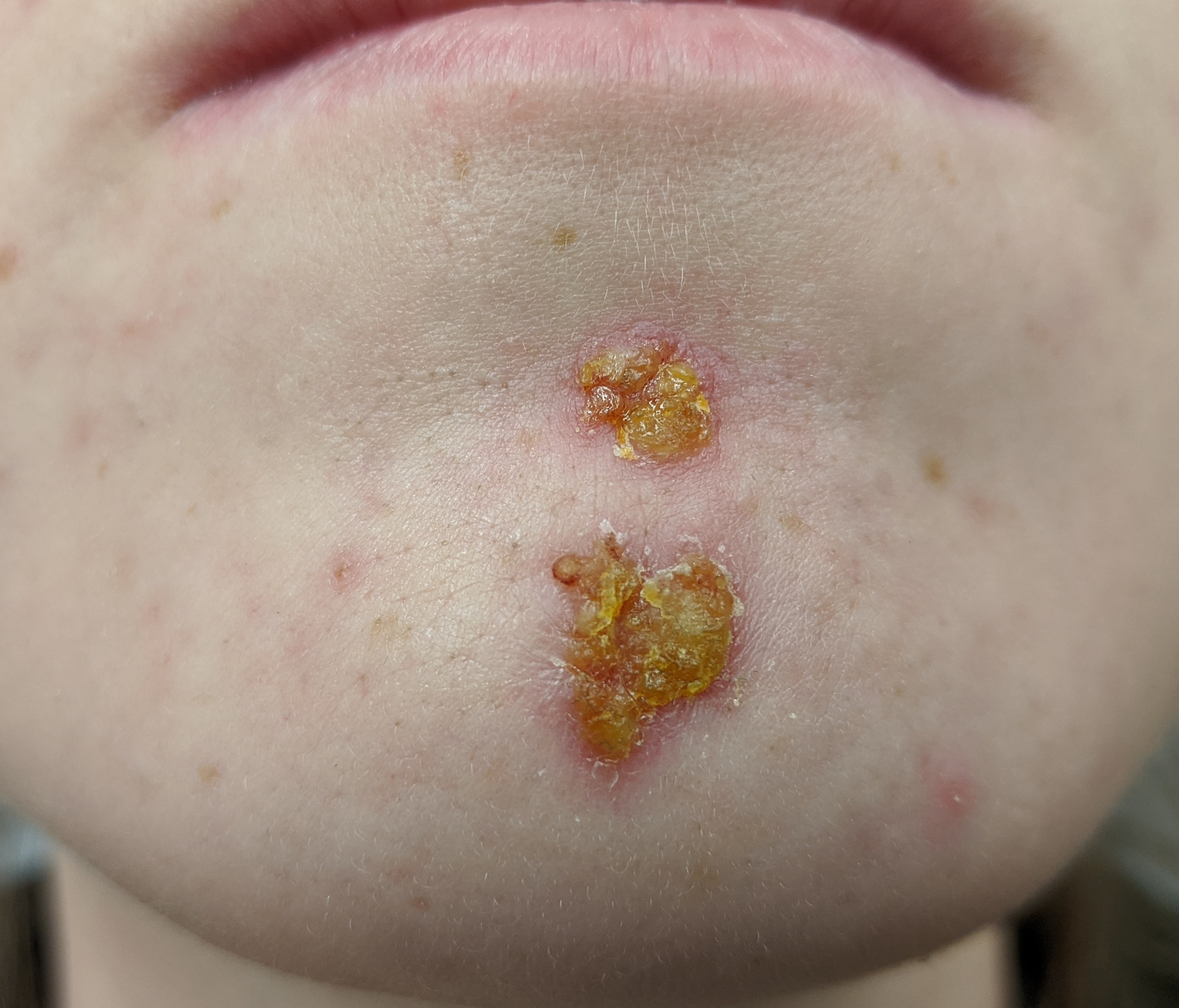 <p>Impetigo</p>