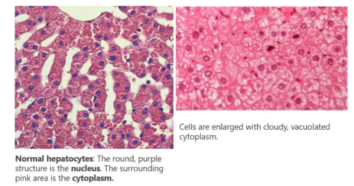 <p>Is this the microscopic appearance of cells that have undergone cellular degeneration, cell death or cell adaption?</p>