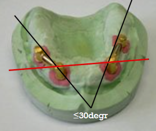 <ol><li><p>bar must withstand from the gingiva<strong> 1-2mm</strong> ( to allow flossing)</p></li><li><p>bar must connect abutments in a <strong>straight line</strong></p></li><li><p>bar must be <strong>perpendicular </strong>towards the rotational movements</p></li><li><p>if 2 bars used they must never be bigger than 30o angle one towards another</p></li><li><p><strong>vestibular flange </strong>of denture should be as short as possible (if there is a vacuum here there will be a hypertrophia of the soft tissue under the bar closing the 1-2mm gap under the gingiva)</p></li></ol><p></p>