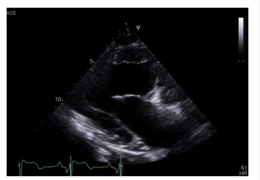 <p>The abnormal ventricular and great-artery positions change the usual heart orientation, so Pulling more laterally will show the parallel great arteries</p>