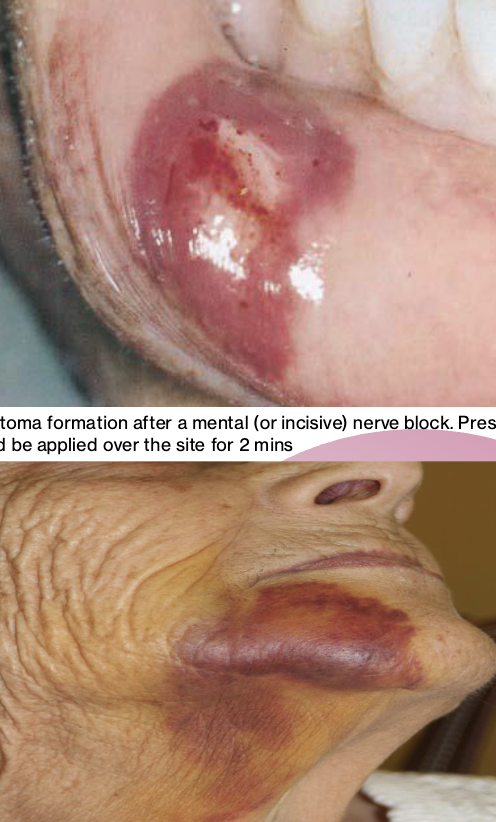 <p><strong>Complication</strong> – After local anesthetic deposition, swelling around the site of injection develops and a hematoma is formed</p>