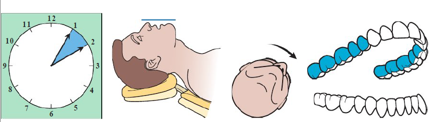 <ul><li><p>Clinician seated 1 to 2 o’ clock position</p></li><li><p>Chin UP</p></li><li><p>Maxillary occlusal perpendicular to floor </p></li><li><p>Patient head: Towards clinician</p></li></ul><p></p>