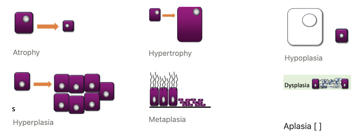 <p><strong><u>ONE: ATROPHY</u></strong></p><p><u>Definition:</u> Decreased cell SIZE (from normal size) which causes the whole organ/tissue to shrink </p><ul><li><p>Less cellular activity results in fewer cell organelles that produce less</p></li></ul><p><u>Examples:</u></p><ol><li><p>Disuse atrophy (eg. muscles)</p></li><li><p>Denervation atrophy (eg. sweeny)</p></li><li><p>Loss of nutrition/hormonal stimulation (eg. small thyroid)</p></li></ol><p></p><p><strong><u>TWO: HYPERTROPHY</u></strong></p><p><u>Definition:</u> Increase in cell SIZE which causes the organ/tissue to get bigger (can be specific cells) </p><ul><li><p>Cells are more active and require more organelles</p></li><li><p>ONLY way for post-mitotic cells (eg. cardiac muscle) to increase in size as cells cannot divide</p></li></ul><p><u>Examples:</u></p><ol><li><p><strong>Physiological</strong></p><ol><li><p>Increased skeletal muscle bulk from prolonged exercise</p></li><li><p>Enlarged smooth muscle cells in the uterus during pregnancy</p></li></ol></li><li><p><strong>Pathological</strong> = Increased ventricle wall thickness due to a stenotic valve</p></li></ol><p></p><p><strong><u>THREE: HYPOPLASIA</u></strong></p><p><u>Definition:</u> Incomplete growth of an organ/tissue that NEVER reached full size</p><ul><li><p>Fewer cells produced </p></li><li><p>Caused by congenital conditions (NOT true cellular adaptations)</p></li></ul><p><u>Examples:</u></p><ol><li><p><strong>Aplasia</strong> = Complete absence of tissue/organ (extreme hypoplasia) eg. aplasia of epididymis</p></li><li><p><strong>Atresia</strong> = Absence of the lumen eg. atresia ani (no opening of anus)</p></li></ol><p></p><p><strong><u>FOUR: HYPERPLASIA</u></strong></p><p><u>Definition:</u> Increased NUMBER of cells which may increase gross size</p><ul><li><p>Stimulated in the same way as hypertrophy (can be both)</p></li><li><p>Usually normal function</p></li></ul><p><u>Examples:</u></p><ol><li><p>Goitre (thyroid hyperplasia)</p></li><li><p>Nodular hyperplasia of the spleen</p></li><li><p>BPH</p></li></ol><p></p><p><strong><u>FIVE: DYSPLASIA</u></strong></p><p><u>Definition:</u> Lack of normal histological architecture in the tissue/organ </p><ul><li><p>Results from developmental/congenital condition OR acquired (scar tissue)</p></li></ul><p><u>Examples:</u></p><ol><li><p>Hip dysplasia</p></li><li><p>Kidney displasia</p></li></ol><p></p><p><strong><u>SIX: METAPLASIA</u></strong></p><p><u>Definition:</u> A fully differentiated cell type changes into another cell type from the same germline </p><ul><li><p>Usually changes into a more durable cell type in response to chronic irritation</p></li></ul><p><u>Example:</u> Squamous metaplasia</p><ol><li><p>Change from secretory ciliated columnar epithelium in the bronchi (loss of mucociliary blanket)</p></li><li><p>Change from secretory columnar cells in the mammary glands</p></li></ol><p></p>