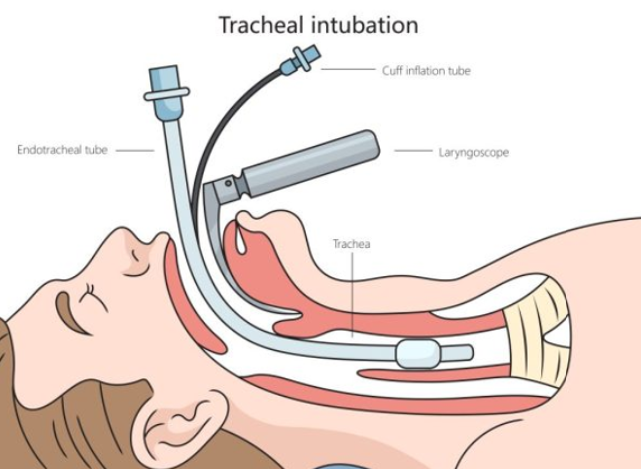 <ul><li><p>Rapid sequence intubation is used in <span style="color: rgb(30, 37, 232);">emergent </span>situations</p></li><li><p>Indications for RSI:</p><ul><li><p><span>•<strong>Airway protection </strong>(e.g., from coma, trauma, overdose)</span></p><p><span>•<strong>Respiratory failure </strong>(e.g., severe COPD/asthma exacerbation)</span></p><p><span>•<strong>Anticipated clinical deterioration </strong>(i.e., sepsis progressing to shock)</span></p></li></ul></li><li><p>Laryngoscope moves mouth down to place ETT down airway</p><ul><li><p>do not want to intubate esophagus - will not help pt breathe </p></li></ul></li><li><p>the ETT is attached to something for ventilations such as a mechanical ventilator </p></li></ul><p></p>