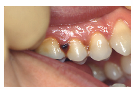 <p>1.what is this lesion?</p><p>2. how to treat/ manage it?</p><p>3. classification of oral lesion in HIV?</p>