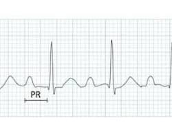 <p>Prolonged PR interval</p>