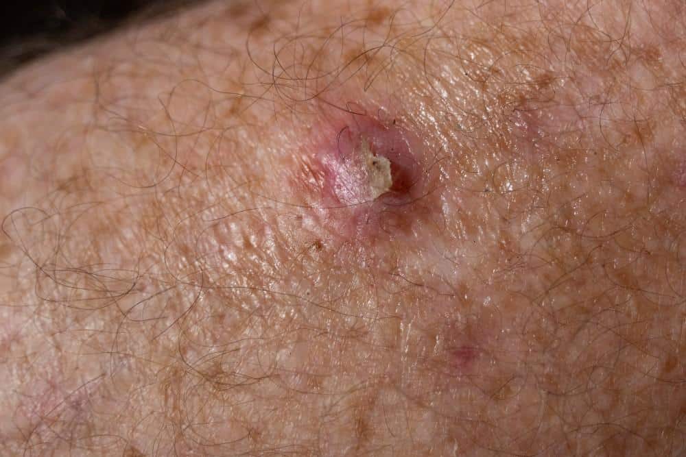<p>A skin cancer arising from squamous cells. It typically appears as a firm, red nodule or a flat sore with a scaly crust. It can develop from actinic keratosis and may invade nearby tissues. </p>