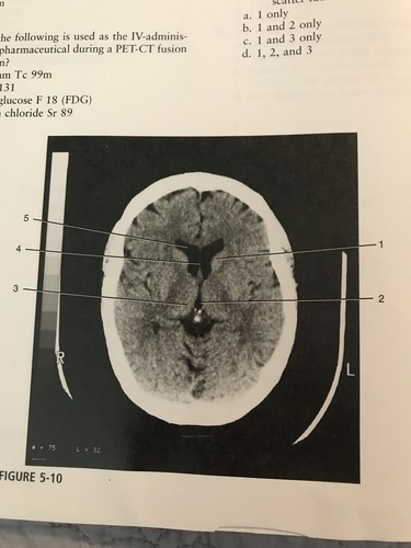 <p>Which number corresponds to the anterior horn of the lateral ventricle</p><p>A) 1 </p><p>B) 5 </p><p>C) 3</p><p>D) 2</p>