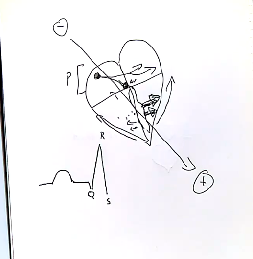 <ul><li><p>ventricular depolarisation</p></li><li><p>signal travels down left and right bundle of His. left bundle fires slightly earlier than right, movement from left to right, so slight donard inflection on ECG</p></li><li><p>movement across Purkinje fibres, bigger signal moving to left than right as more Purkinje fibres in left heart, causes upard inflection on ECG</p></li><li><p>then signal moves up walls of ventricles toards base (up and to the right), causes donard inflection</p></li></ul><p></p>